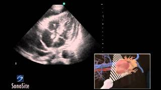 Fetal Echocardiography Tetralogy of Fallot [upl. by Boehmer28]