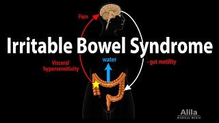 Irritable Bowel Syndrome Pathophysiology Symptoms Causes Diagnosis and Treatment Animation [upl. by Goldberg]