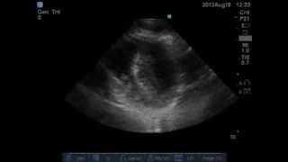 Hypovolemia LV endsystolic obliteration on Echo PSAX [upl. by Leirvag262]