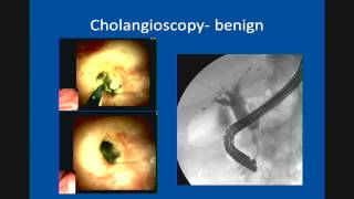 Primary Sclerosing Cholangitis Update in Management [upl. by Atenek639]