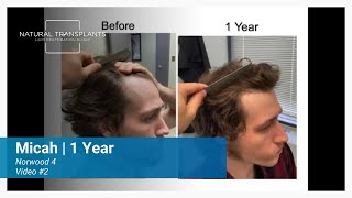 One Year Later Norwood 4 Incredible Hair Transformation Journey  Dr Blumenthal Micah [upl. by Julianna344]