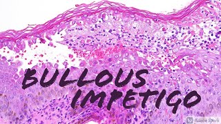 Bullous Impetigo vs Staphylococcal Scalded Skin SSSS 5Minute Pathology Pearls [upl. by Etnaud]