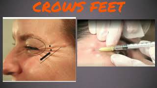 Chapter 4Botox injection for crows feet [upl. by Atisor]