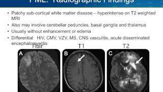 Progressive Multifocal Leukoencephalopathy PML [upl. by Thgiwed]