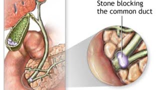 Choledocholithiasis amp Cholangitis [upl. by Greggory]