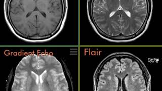 T1 T2 FLAIR and Gradient Echo pulse sequences [upl. by Anihta795]