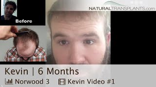 Norwood 3  Norwood Men’s Hair Loss Scale [upl. by Ahsyekat897]