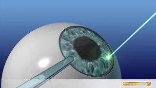 AugenOP mit Laser So funktioniert LASIK [upl. by Sesiom]