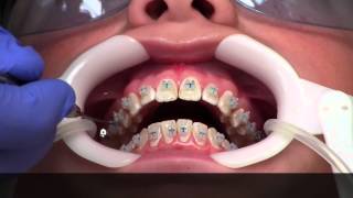 Getting Braces  How [upl. by Garceau]