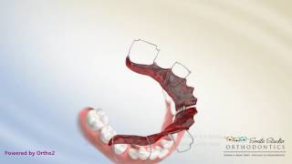 Schwartz Appliance  Lower Expander  Orthodontic Treatment [upl. by Rivalee]