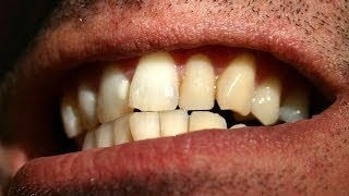 How to Straighten Crooked Teeth  Tooth Care [upl. by Edgar]