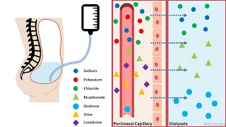 Peritoneal Dialysis [upl. by Esirec]