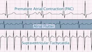 EKG Patterns  Premature Atrial amp Ventricular Contractions PACs amp PVCs [upl. by Belter]