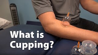 What is Cupping [upl. by Wiburg]