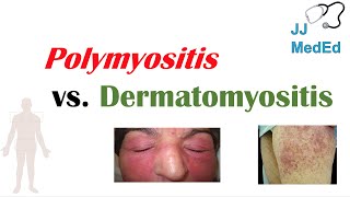 Idiopathic Inflammatory Myopathies  Polymyositis vs Dermatomyositis [upl. by Nered]