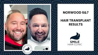 ADVANCED HAIR LOSS  NORWOOD 6amp7  HAIR TRANSPLANT RESULTS  BEFORE amp AFTER  SMILE HAIR CLINIC [upl. by Phyl]