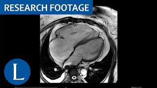 Cine cardiovascular MRI of the right ventricle in a patient with heart failure symptoms [upl. by Aaren]