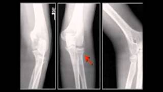 LearningRadiology 57 Elbow FracturesDislocations [upl. by Slavin]