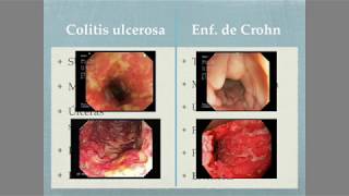 Colitis ulcerosa Vs Enfermedad de Crohn [upl. by Okiron]