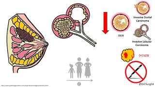 Breast Disease  Risk Lesions Pt 2  DCIS [upl. by Agan972]