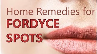 Home Remedies for Fordyce Spots  Treatment Methods Natural Cure [upl. by Morlee795]