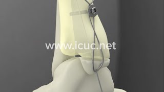 Medial Malleolus ORIF  ICUC® Video [upl. by Vocaay]