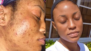 SKINCARE ROUTINE FOR OILY ACNE PRONE SENSITIVE SKIN  How I deal with Hyper Pigmentation amp Texture [upl. by Oicor]