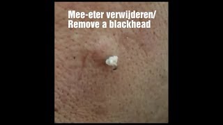 Grote meeeter verwijderen  Remove a big blackhead [upl. by Kala]