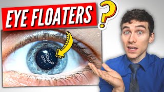 3 Must Know Facts About EYE Floaters [upl. by Esille]