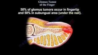 Glomus Tumor Of The Finger  Everything You Need To Know  Dr Nabil Ebraheim [upl. by Anitaf178]