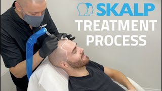 Skalp® Scalp Micropigmentation Treatment Process [upl. by Holli]