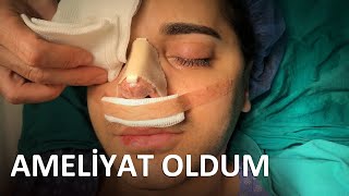 AMELİYAT OLDUM  BURNUMU NASIL KESTİLER [upl. by Romine]