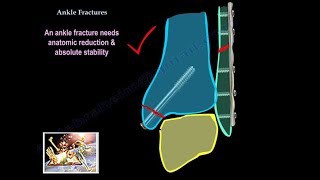 Ankle Fractures  Everything You Need To Know  Dr Nabil Ebraheim [upl. by Tiduj]