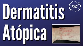 Dermatitis Atópica Lo básico y lo no tan básico [upl. by Oninotna]