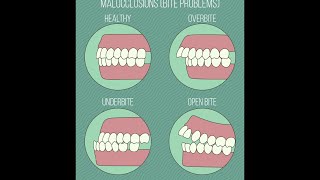 Different Types of Malocclusions [upl. by Layor]