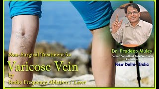 Latest Varicose Vein Treatment [upl. by Baptist]