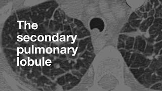 Pneumothorax  Hydro pneumothorax  Emphysème pulmonaire [upl. by Struve]