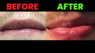 How to treat PIGMENTATION around the MOUTH  LIPS  Home Remedies Creams and Treatments हिंदी में [upl. by Akihsal127]