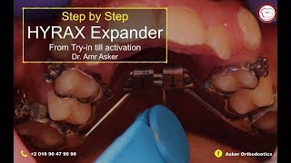 hYRAX expander step by step in orthodontics try incementation and activation by dr Amr Asker [upl. by Alodie]