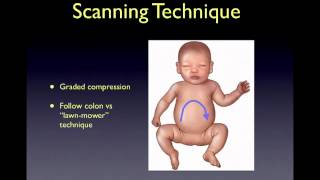 intussusception [upl. by Alaaj]