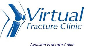 Avulsion fracture to ankle [upl. by Spring890]