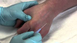 Intravenous Catheter Placement [upl. by Ohaus748]