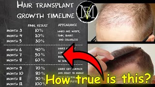 Hair Transplant growth timeline  Month 19  Norwood 5 [upl. by Lait]