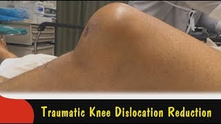 Traumatic Knee Dislocation Reduction [upl. by Atikan575]