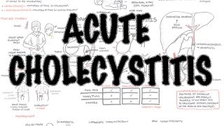 Acute Cholecystitis  Overview signs and symptoms pathophysiology treatment [upl. by Ainet]