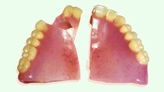 How to Repair a Broken Denture in 25 Minutes [upl. by Rehportsirhc]