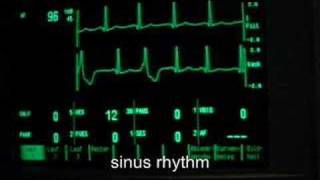 Premature Ventricular Contractions PVCs Animation [upl. by Hetti795]