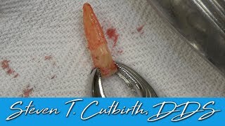 Extracting Mandibular Anterior Tooth  Dental Minute with Steven T Cutbirth DDS [upl. by Jarin489]