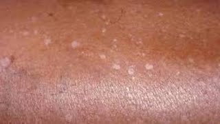 What Are the Signs of Skin Cancer [upl. by Lewls]