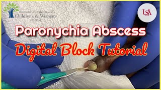 Finger Paronychia Emergency amp Digital Block Tutorial [upl. by Smail810]